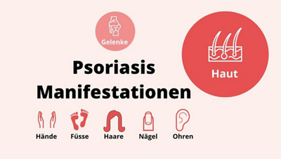 03-psoriasis-manifestationen