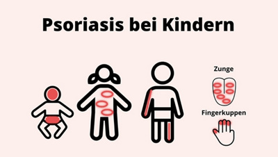 05-psoriasis-bei-kindern