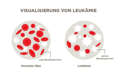 Visualisierung von Leukämie