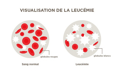 Visualisation  de la leucemie
