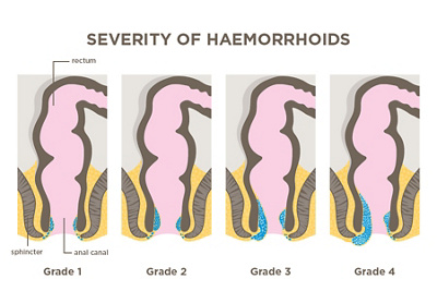 Severity of haemorrhoids