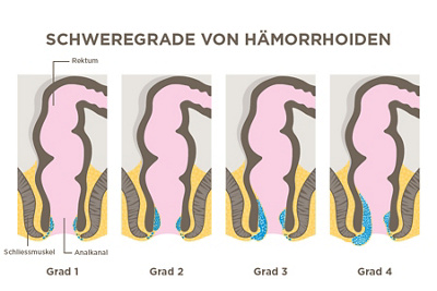 Schweregrade von Hämrroiden