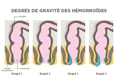 Degres de gravite des hemorroides