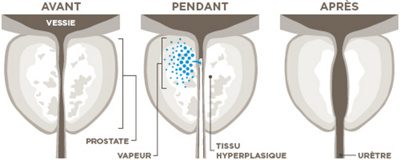 La visualisation de la traitement Rezum