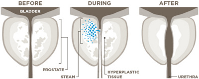 Visualisation of Rezum therapy