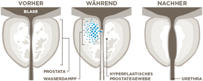 Visualisierung Rezumtherapie