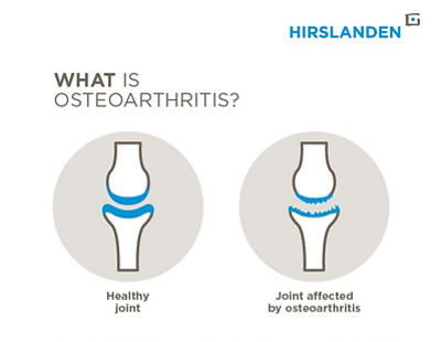 What is osteoarthritis? Visualisation of a healthy and an affected joint.