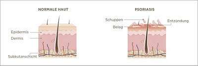 Infografik normale Haut und Psoriasis