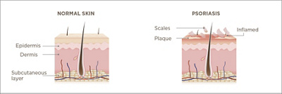 Infographie peau normale et psoriasis