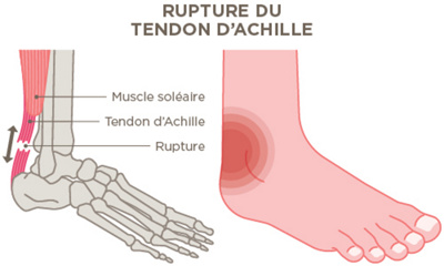 Rupture du tendon d'achille