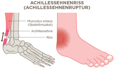 Achillessehnenruptur Infografik