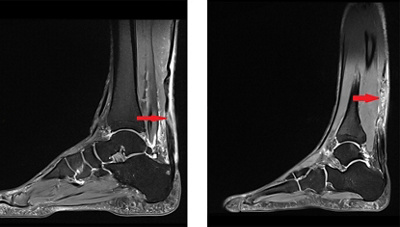 2-mri-achillesehnenriss