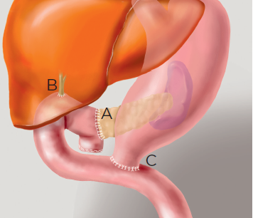 Abbildung Bauchspeicheldruese nach der Operation
