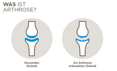Was ist Arthrose? Visualisierung eines gesunden und eines betroffenen Gelenkes.