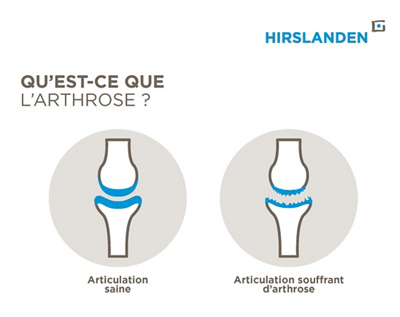 Qu'est-ce que l'arthrose ? Visualisation d'une articulation saine et d'une articulation touchée.