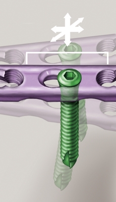 Abbildung von winkelstabilen Schrauben für die minimalinvasive Knochenbruchversorgung