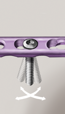 Abbildung von herkömmlichen Schrauben für die minimalinvasive Knochenbruchversorgung