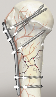 Abbildung einer befestigten Platte am Knochen mit herkömmlichen Schrauben.
