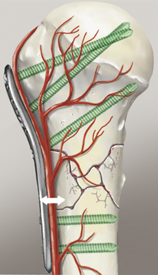 Abbildung einer befestigten Platte am Knochen mit winkelstabilen Schrauben.