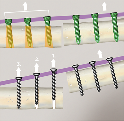 Abbildung Simulation des Ausreisswiderstands von winkelstabilen und herkömmlichen Implantaten