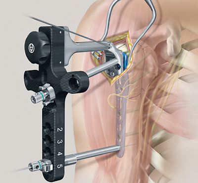 Winkelstabile PHILOS-Platte für minimalinvasive Versorgung mithilfe eines Zielbuegelaufsatzes