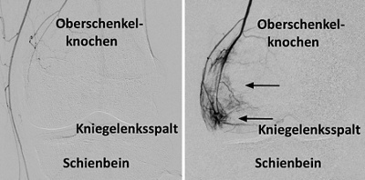 Angiografische Darstellung der Kniegefässe