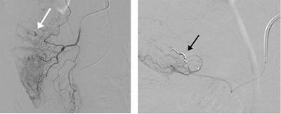 Angiographischer Nachweis