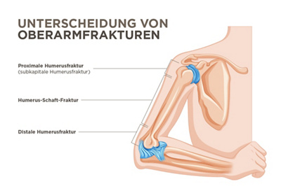 Arten von Oberarmbrüchen