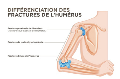 Types de fractures de l'humérus