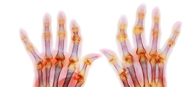 How your body works: Arthritis
