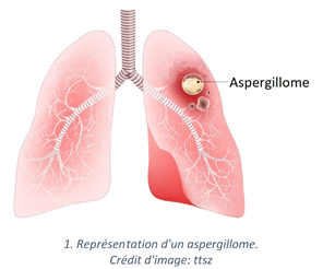 Aspergillose