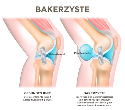 Baker Zyste Visualisierung
