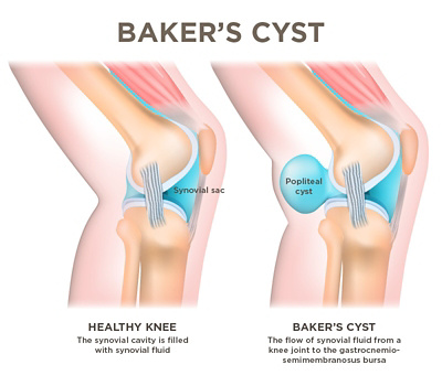 Baker's cyst
