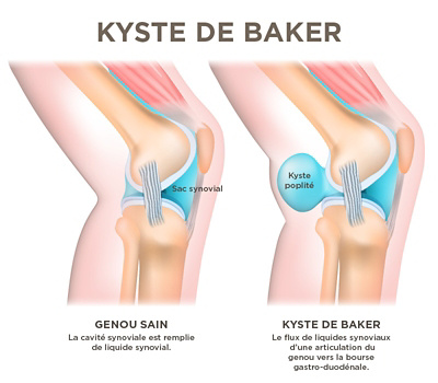 Kyste de baker