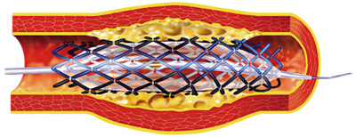 Ballonkatheter_Stenteinlage_2_DL