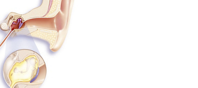 Balloon Dilation: a Minimally-Invasive Alternative to Grommets