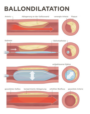 Visualisierung einer Balloondilatation 