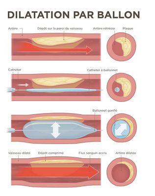Visualisation d'une dilatation de ballons