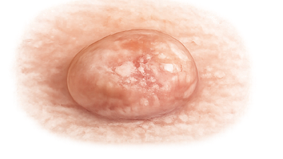 Basalzellkarzinom-1