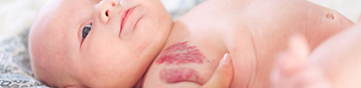 Strawberry haemangioma on newborn baby’s foot / small birthmark on newborn baby’s forehead
