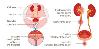 Illustration of the development of cystitis
