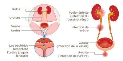 Illustration de développement de la cystite