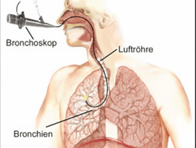Illustration zu einer Bronchioskopie 