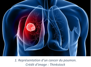 Cancer_poumon
