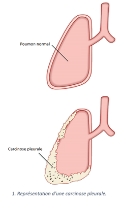 Carcinose_pleurale