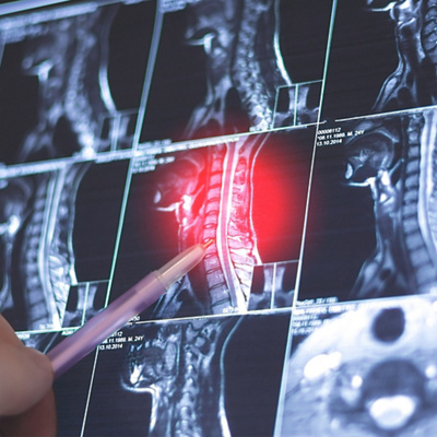 Causes Head and Neck Cancer