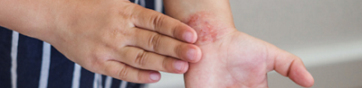 Chemical burns in children: Risks and prevention tips