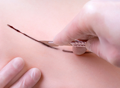 Chirurgie-dresdermal