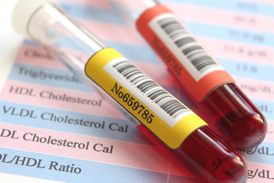 Cholesterol_gettyimages-507480060-1152x768