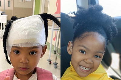 Cochlear implant 3- 1152 x 768 - 1